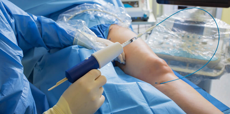 Радиочастотная абляция вен (РЧА) в Алматы